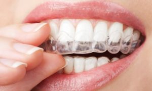 Benefits of Invisalign | Straightening Your Teeth