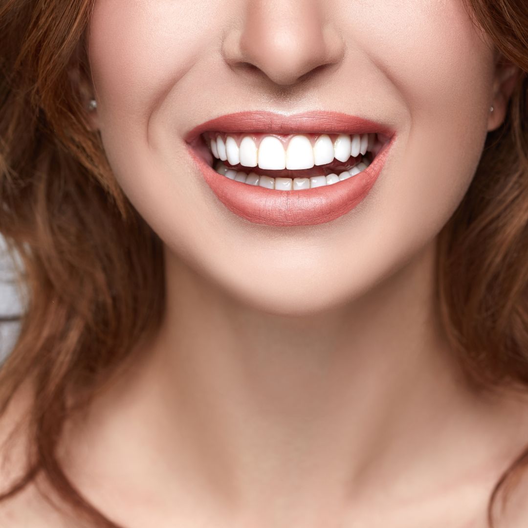 Porcelain Veneers