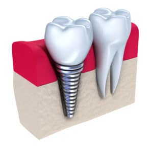 Dental Implants Treatment in Arlington VA